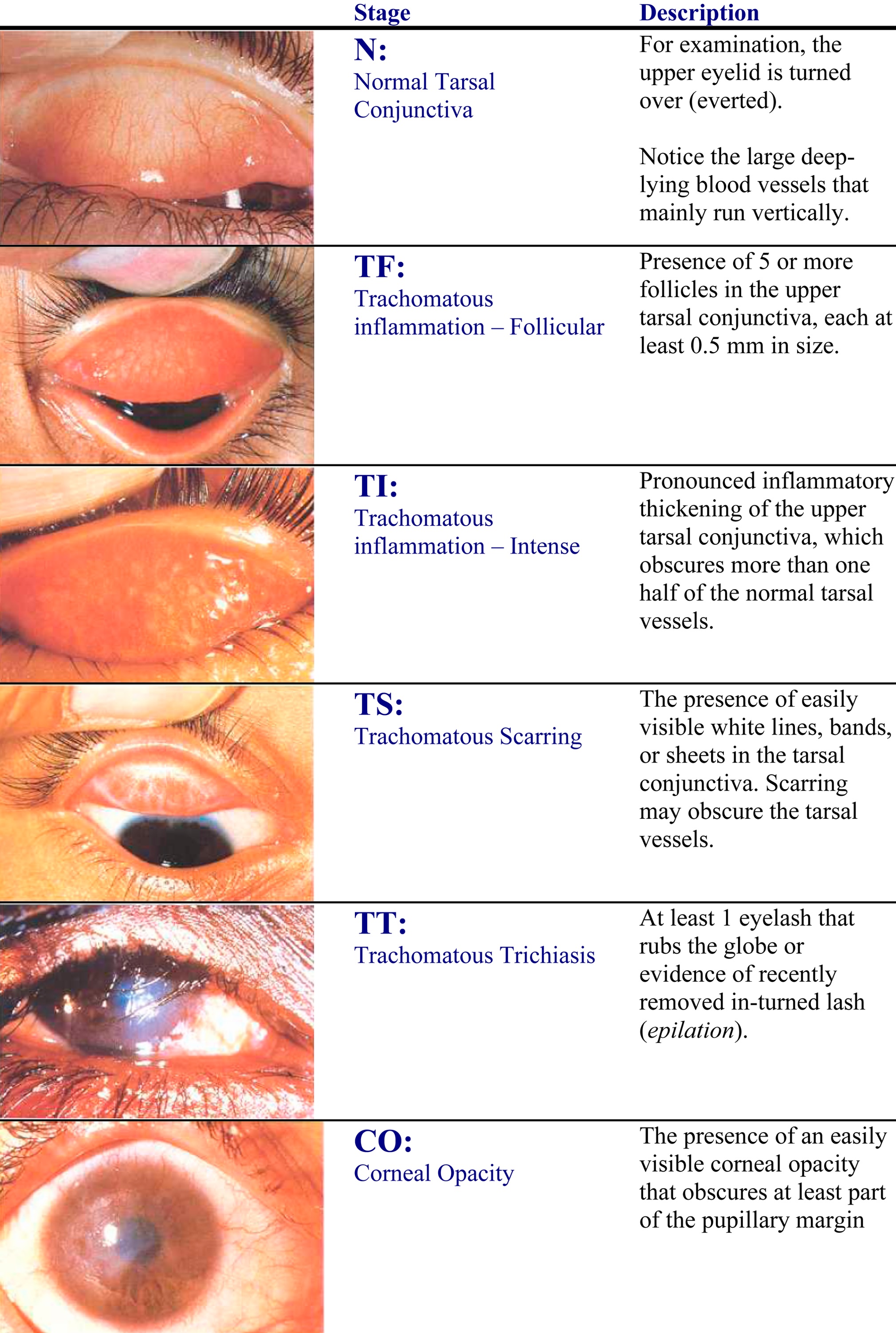 Stages of trachoma